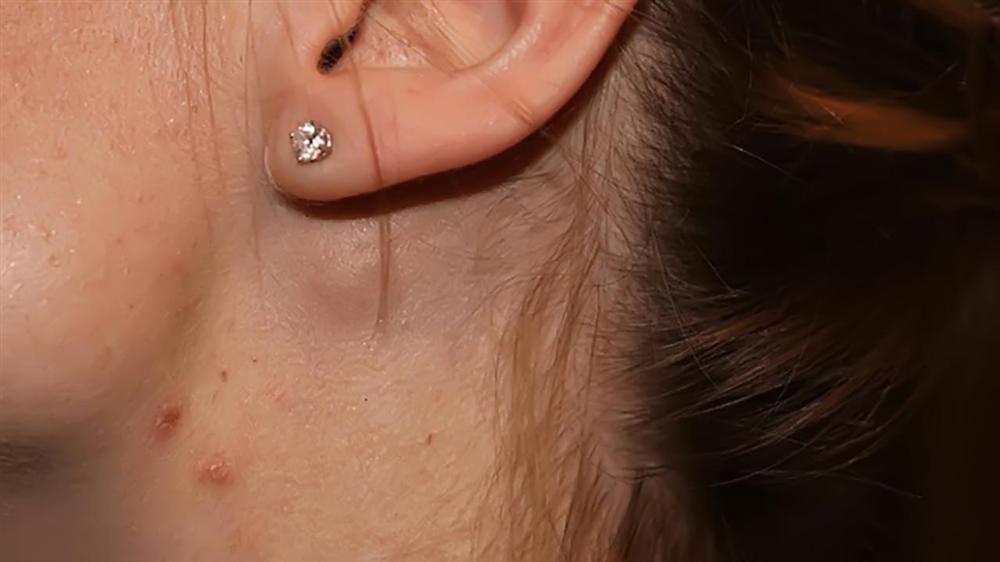 Dạng ung thư máu MC Diệu Linh mắc phải phổ biến nhất trong 3 dạng ung thư máu, gây tổn hại hệ miễn dịch-3