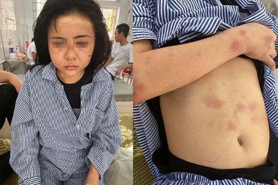 Gã trai đánh đập cô gái suốt 2 giờ vì không được đáp lại tình cảm