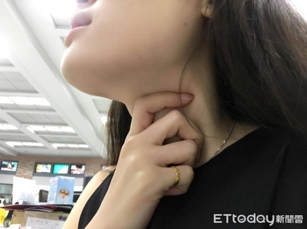 Người phụ nữ dễ bị sặc khi ăn uống, khàn tiếng kéo dài 3 tháng, đi khám mới biết mình mắc bệnh ung thư-2