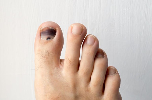 Móng chân chuyển màu đen có thể là nốt ruồi lành tính nhưng nhiều khi cũng là dấu hiệu của các bệnh, bao gồm cả ung thư-1