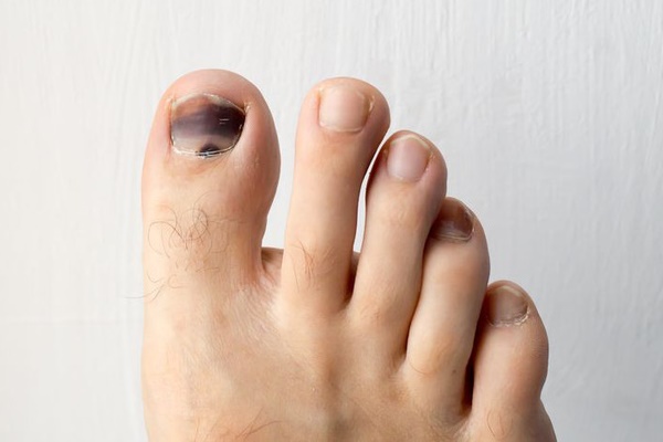 Bỗng thấy nốt ruồi dần biến đổi theo 5 cách này, coi chừng tế bào ung thư đang dần len lỏi trong cơ thể bạn-7