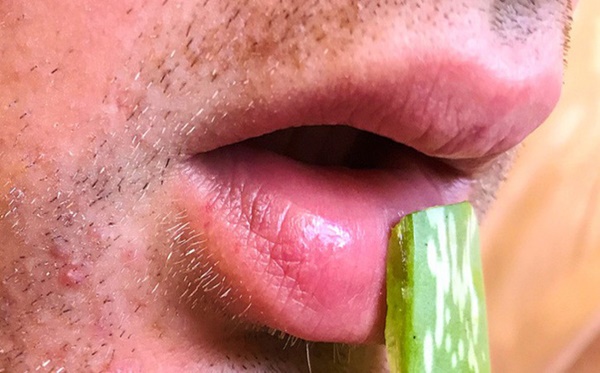 8 cách đơn giản trị bệnh lở miệng hiệu quả-5