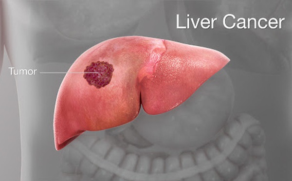 4 cách để phong tỏa tế bào ung thư gan, đừng để cứ hễ phát hiện là đã ở giai đoạn muộn-1