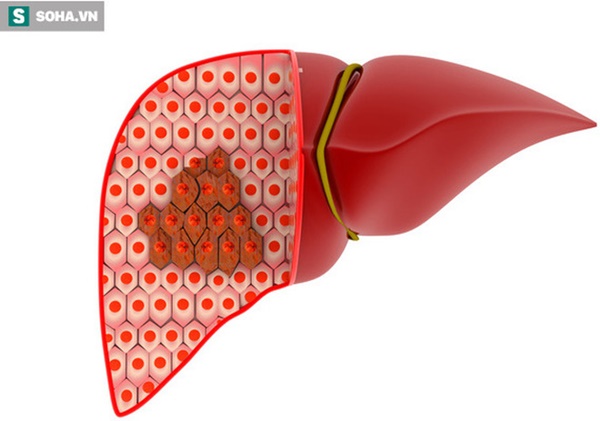 4 cách để phong tỏa tế bào ung thư gan, đừng để cứ hễ phát hiện là đã ở giai đoạn muộn-2