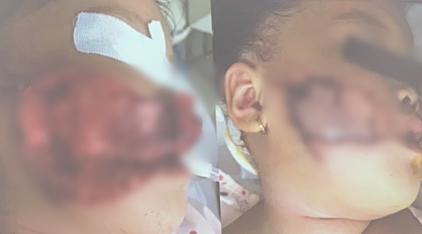 Thương tâm: Đang ăn xúc xích, cháu bé 17 tháng tuổi bị chó hàng xóm ngoạm nát mặt-2