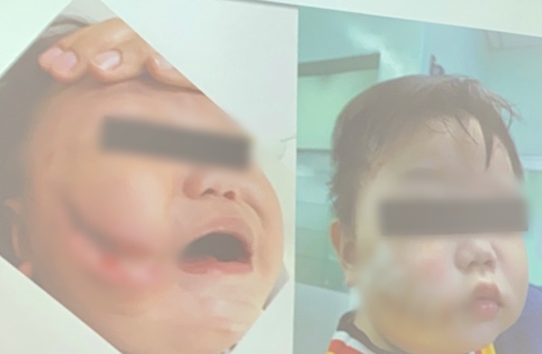 Thương tâm: Đang ăn xúc xích, cháu bé 17 tháng tuổi bị chó hàng xóm ngoạm nát mặt-4