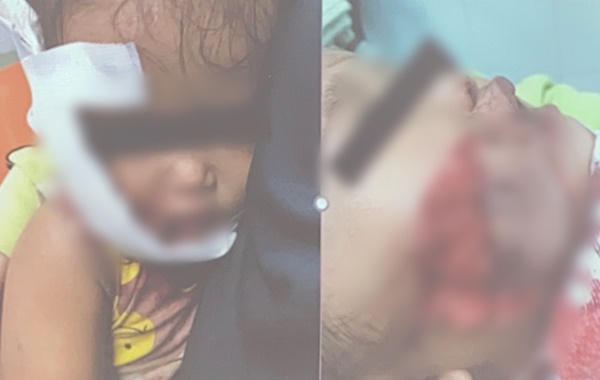 Thương tâm: Đang ăn xúc xích, cháu bé 17 tháng tuổi bị chó hàng xóm ngoạm nát mặt-5