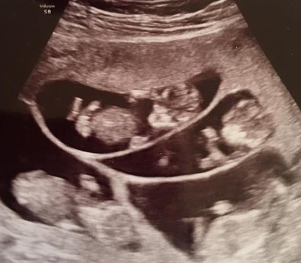 Từng khiến thế giới ngỡ ngàng vì ca sinh 7 thành công cách đây hơn 20 năm, đôi vợ chồng và những đứa trẻ ngày ấy giờ ra sao?-3