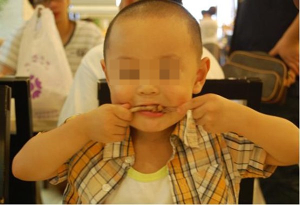 Bé trai 5 tuổi bị hoại tử ruột sau bữa ăn, bác sĩ cảnh báo 3 món ăn độc hại không nên cho trẻ ăn quá nhiều và thường xuyên-1
