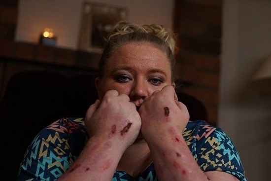 Người phụ nữ mắc căn bệnh đau đớn nhất thế giới