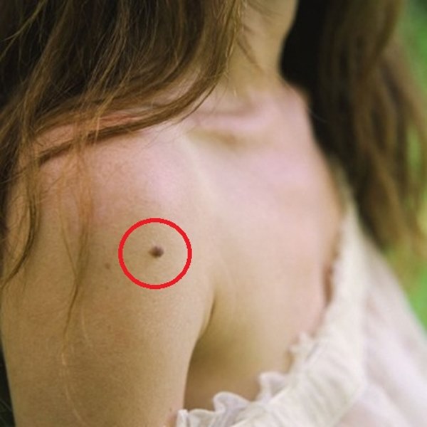 Da đang láng mịn bỗng mọc ra” 3 thay đổi bất thường này, hãy đi khám ngay bởi đó là dấu hiệu tế bào ung thư đang xâm lấn cơ thể-2