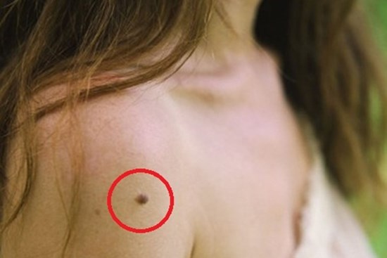Da đang láng mịn bỗng “mọc ra” 3 thay đổi bất thường này, hãy đi khám ngay bởi đó là dấu hiệu tế bào ung thư đang xâm lấn cơ thể