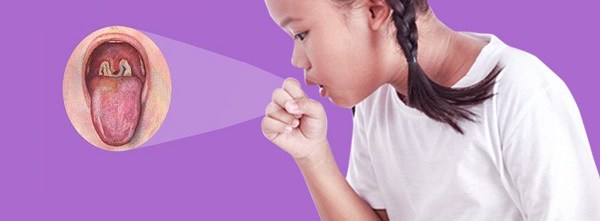 Bé gái mắc bạch hầu tử vong khiến trăm người cách ly: Bệnh bạch hầu là gì, lây nhiễm không?-2