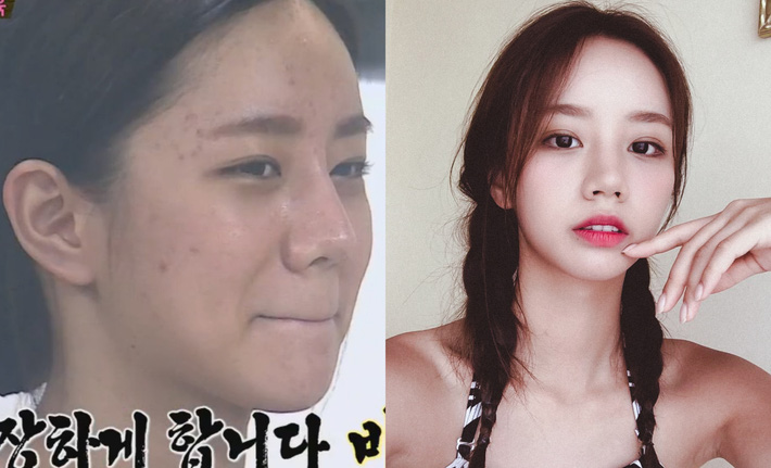 Bỏ đi lớp makeup đậm, không ít sao Hàn gây ngã ngửa với làn da đen nhẻm, sần sùi lấm tấm mụn-7