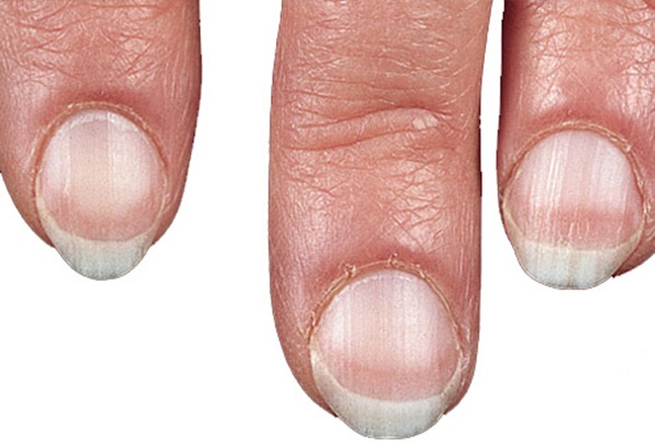 Bất thường trên móng tay tiết lộ sức khỏe của bạn-1