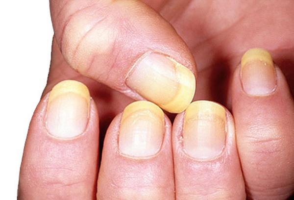 Bất thường trên móng tay tiết lộ sức khỏe của bạn-3