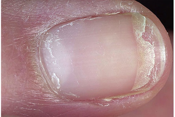 Bất thường trên móng tay tiết lộ sức khỏe của bạn-6