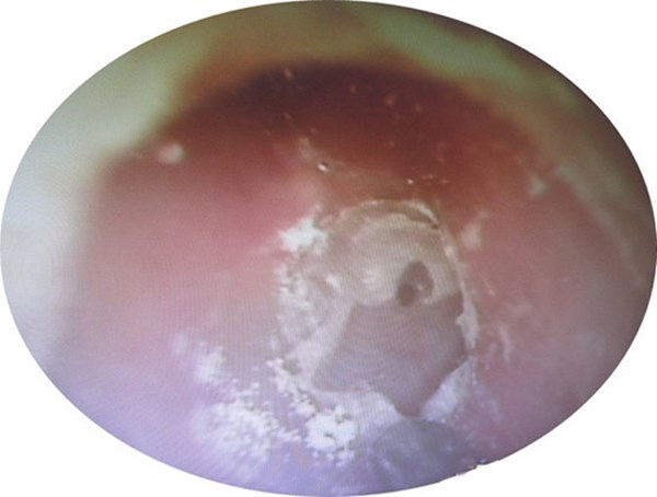 Người phụ nữ suýt bị điếc vì thói quen giống nhiều người Việt-2