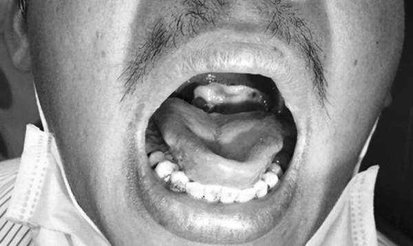 Liên tiếp xuất hiện các ổ bệnh bạch hầu tại Việt Nam: Đây là lý do bạch hầu có thể lây mạnh và vô cùng nguy hiểm cho tính mạng người bệnh-1