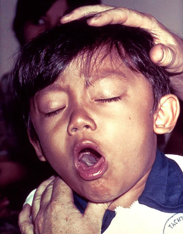 Liên tiếp xuất hiện các ổ bệnh bạch hầu tại Việt Nam: Đây là lý do bạch hầu có thể lây mạnh và vô cùng nguy hiểm cho tính mạng người bệnh-3