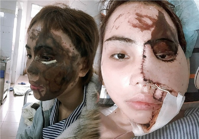 Cô gái bị chồng sắp cưới tạt axit biến dạng gương mặt ở Đà Nẵng trở lại với diện mạo bất ngờ, còn tiết lộ trên Tiktok điều khó tin-1