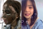 Cô gái bị chồng sắp cưới tạt axit lần đầu lộ diện cả khuôn mặt, tiết lộ 16 lần phẫu thuật đau đớn-4