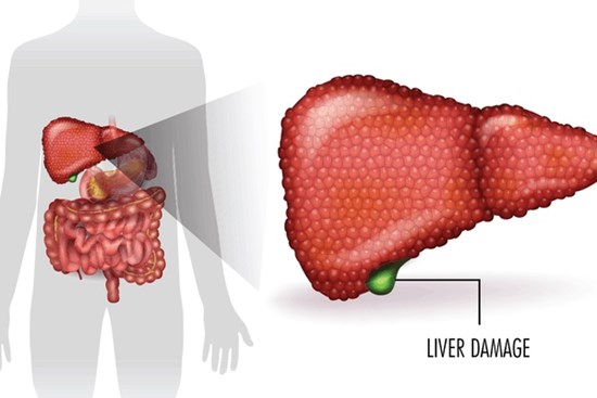 Uống rượu làm hỏng gan chỉ đứng thứ hai, 