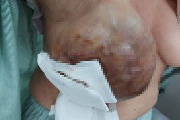 Mang khối u ban đầu chỉ như quả trứng chim cút và có thể lành tính, nhưng 20 năm tự điều trị đã dẫn đến ung thư vú ác tính-1