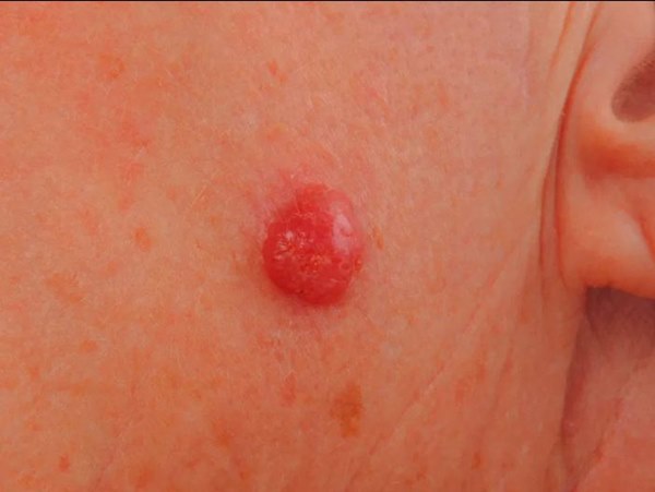 Bỗng thấy nốt ruồi dần biến đổi theo 5 cách này, coi chừng tế bào ung thư đang dần len lỏi trong cơ thể bạn-3