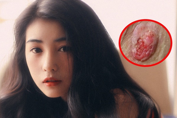 Đi vệ sinh có 3 dấu hiệu này, coi chừng ung thư ruột gõ cửa-4