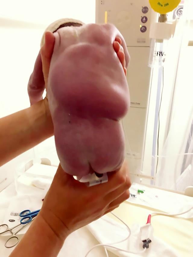 Sinh ra với 1 cục bướu lớn trên lưng, nguyên nhân do thai nhi đã làm 1 việc không tưởng trong lúc mổ để cứu sống cả mẹ và con-1