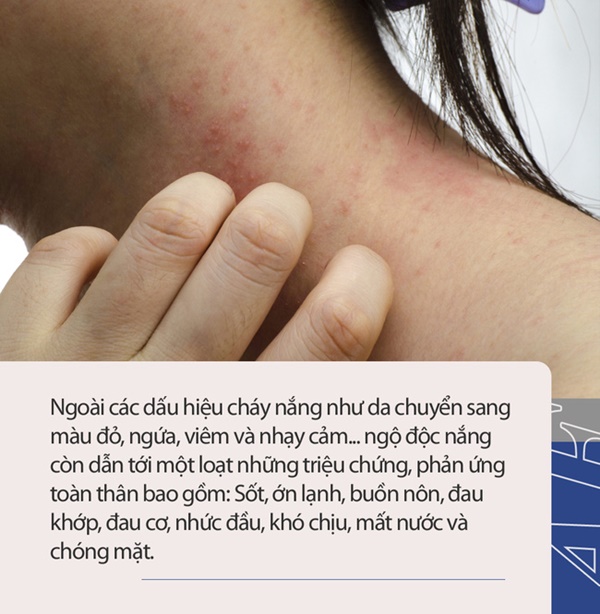 Chuyên gia da liễu giải thích ngộ độc nắng là gì, triệu chứng, cách khắc phục và ngăn ngừa-2