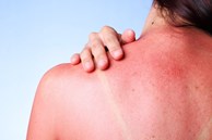 Chuyên gia da liễu giải thích ngộ độc nắng là gì, triệu chứng, cách khắc phục và ngăn ngừa