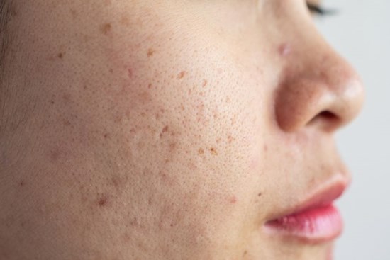 Điều gì khiến lỗ chân lông cứ ngày một