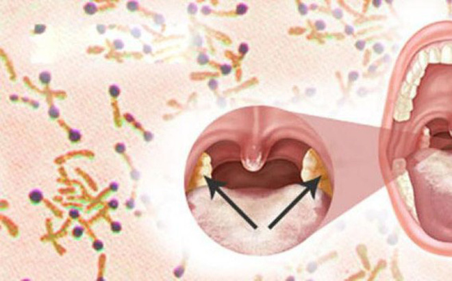 TS Việt tại Mỹ: Bệnh bạch hầu và quá khứ cực kỳ đáng sợ, chỉ có 1 cách phòng bệnh duy nhất-1