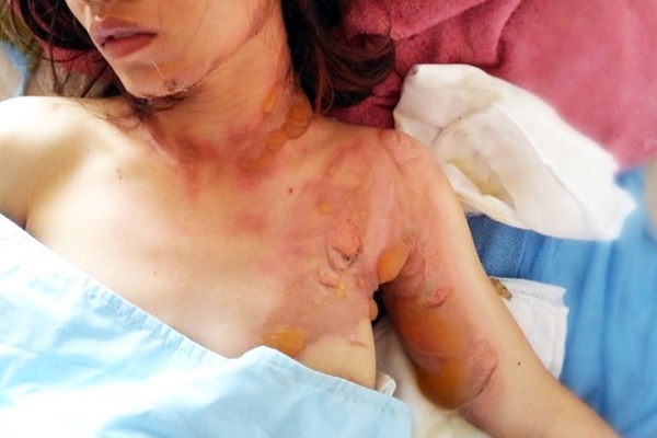 Cô gái xinh đẹp và sự cố bỏng kinh hoàng ngày khai trường: Mình đã sống lại trên đường tìm đến cái chết!-11