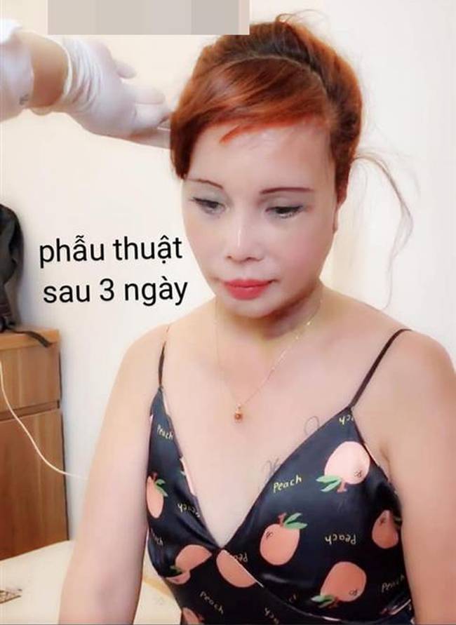 Diện mạo mới của cô dâu 62 tuổi ở Cao Bằng sau 3 ngày khiến dân mạng khiếp vía vì hậu phẫu căng da mặt-3
