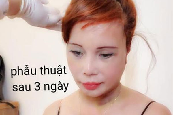 Cô dâu 63 tuổi ở Cao Bằng lại tiếp tục lộ diện khuôn mặt biến dạng, sưng phù không thể nhận ra-6