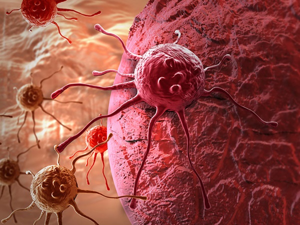 Cứ nghĩ đang béo lên, cô bé 11 tuổi đi khám mới biết bị ung thư buồng trứng: Bệnh ngày càng trẻ hóa, hãy cảnh giác với những tín hiệu của bệnh!-3