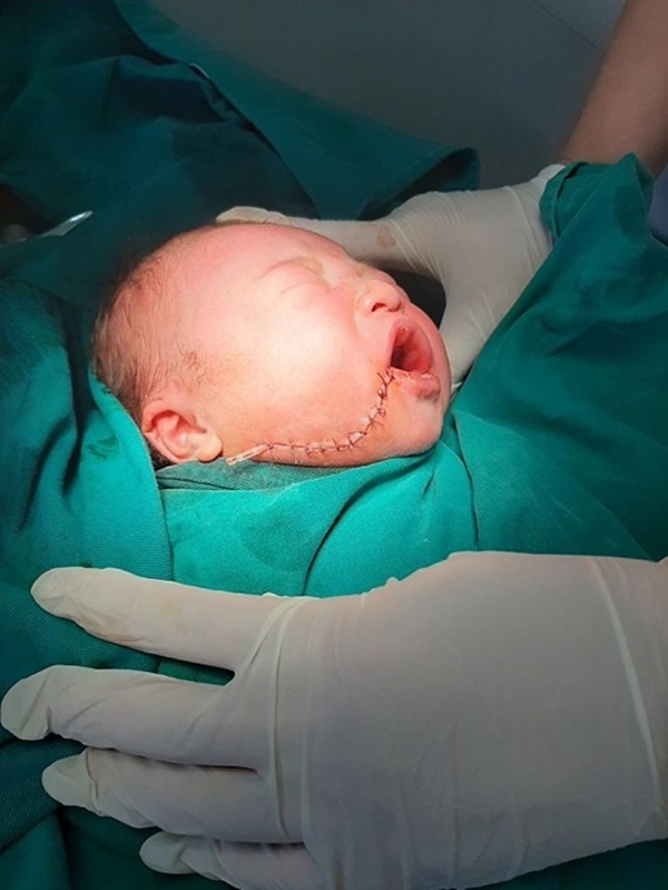Sinh tại nhà, trẻ sơ sinh rách mặt vì rơi vào dao cắt rốn-1