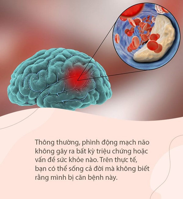 Người phụ nữ 50 tuổi bị vỡ mạch máu não, nhập viện cấp cứu chỉ vì gắng sức hát karaoke quá cao-2