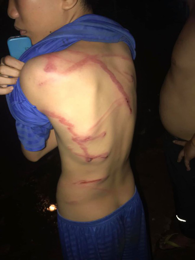 Cha dùng dây điện đánh con trai 12 tuổi thương tích đầy mình vì lấy trộm thẻ điện thoại nạp game-1