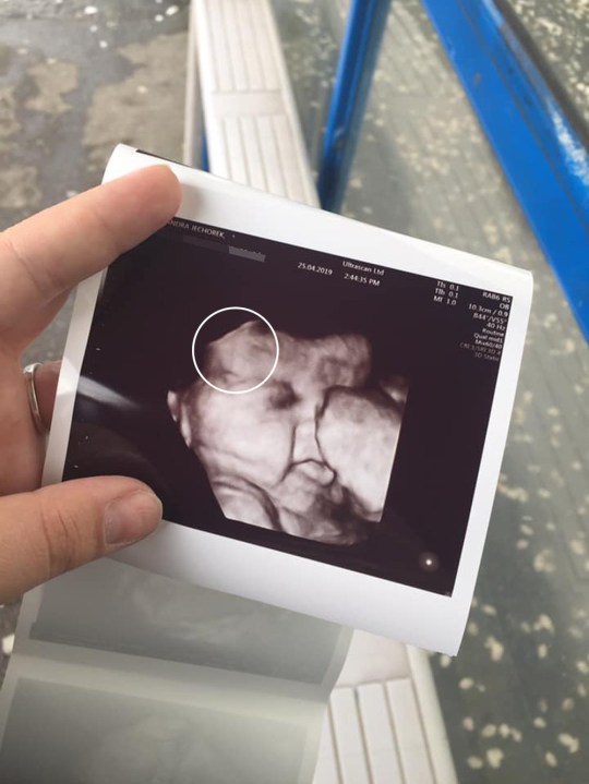 Siêu âm bác sĩ nhìn thấy thai nhi có 1 điểm đặc biệt, vừa chào đời em bé đã lập tức nổi tiếng cả bệnh viện-1
