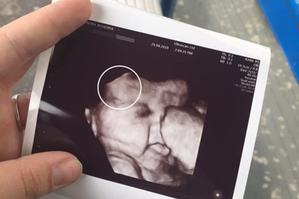 Dùng paracetamol khi đau bụng, người mẹ đau đớn nhìn hình hài con lúc chào đời-4