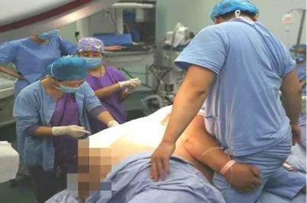 Sản phụ ngoại cỡ lên bàn đẻ nặng tới 145kg, bác sĩ chật vật mới gây tê được để mổ lấy thai-1