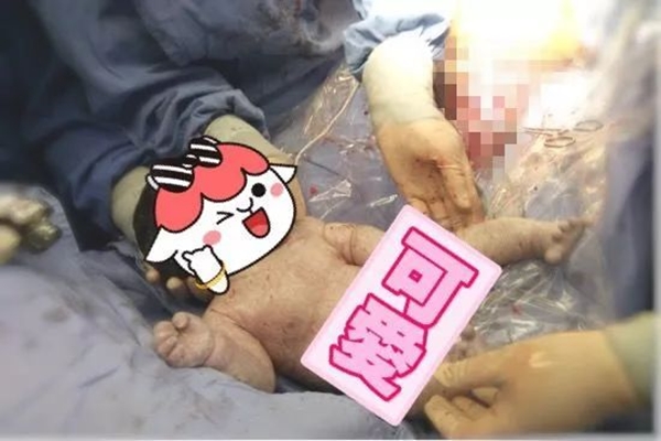 Sản phụ ngoại cỡ lên bàn đẻ nặng tới 145kg, bác sĩ chật vật mới gây tê được để mổ lấy thai-4