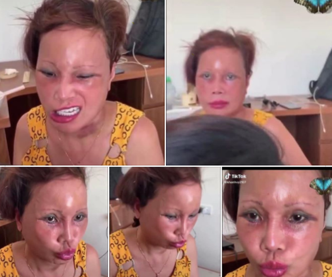 Cô dâu 63 tuổi ở Cao Bằng lại tiếp tục lộ diện khuôn mặt biến dạng, sưng phù không thể nhận ra-1