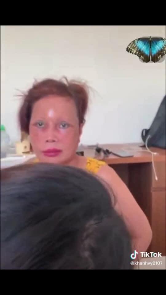 Cô dâu 63 tuổi ở Cao Bằng lại tiếp tục lộ diện khuôn mặt biến dạng, sưng phù không thể nhận ra-3