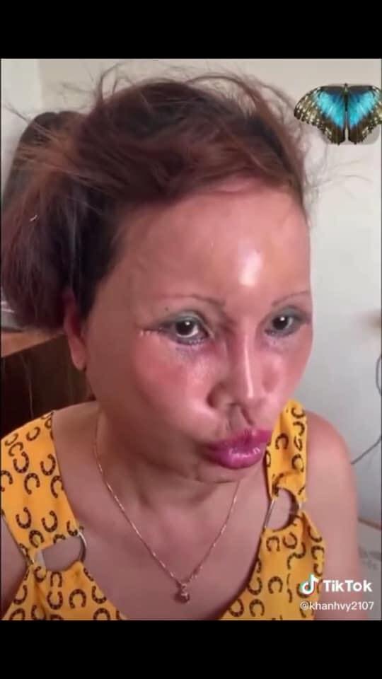 Cô dâu 63 tuổi ở Cao Bằng lại tiếp tục lộ diện khuôn mặt biến dạng, sưng phù không thể nhận ra-4