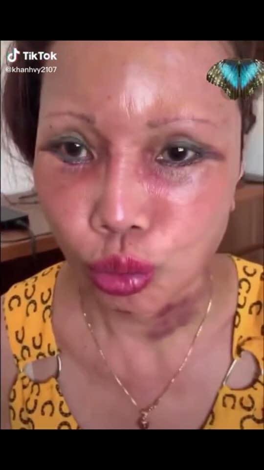 Cô dâu 63 tuổi ở Cao Bằng lại tiếp tục lộ diện khuôn mặt biến dạng, sưng phù không thể nhận ra-5